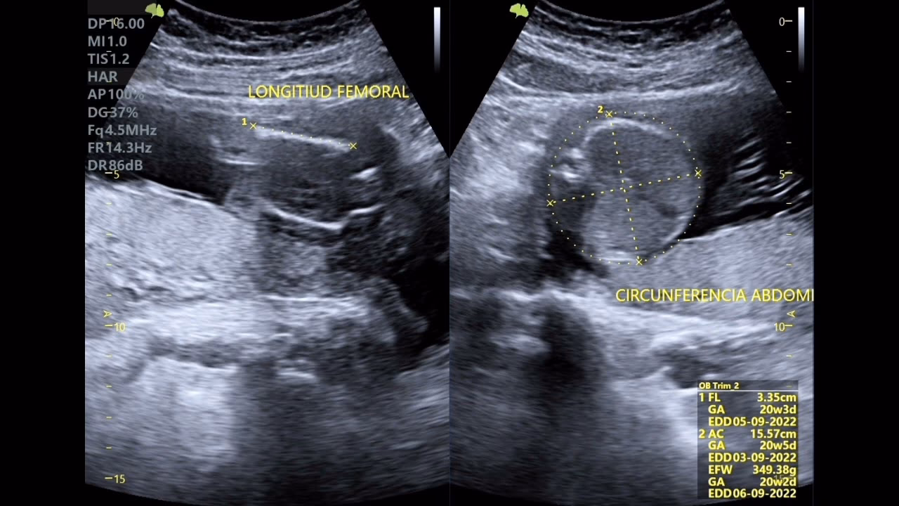 ¿Cómo puedo saber cuánto mide mi bebé según la longitud del fémur?