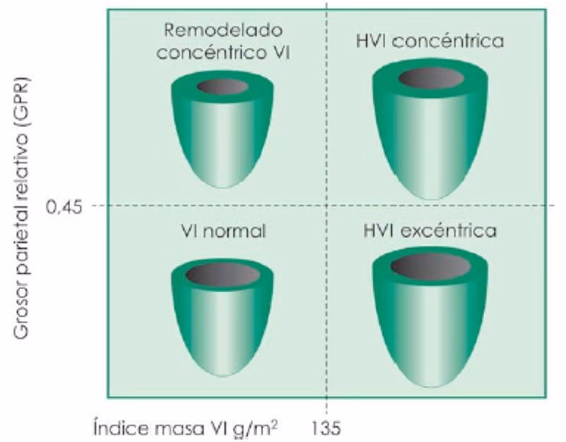 ¿Cómo se calcula la masa del ventrículo izquierdo?