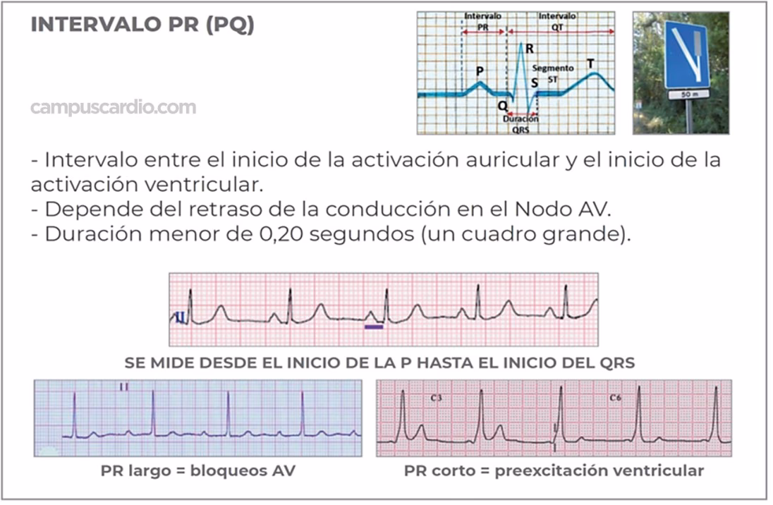 ¿Cómo calcular el QRS en el electrocardiograma?