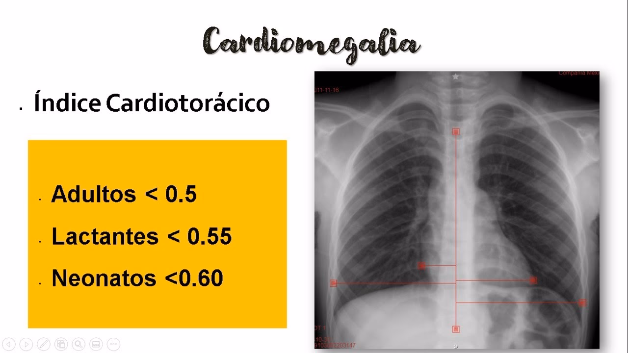 ¿Cómo calculo el índice cardiaco?