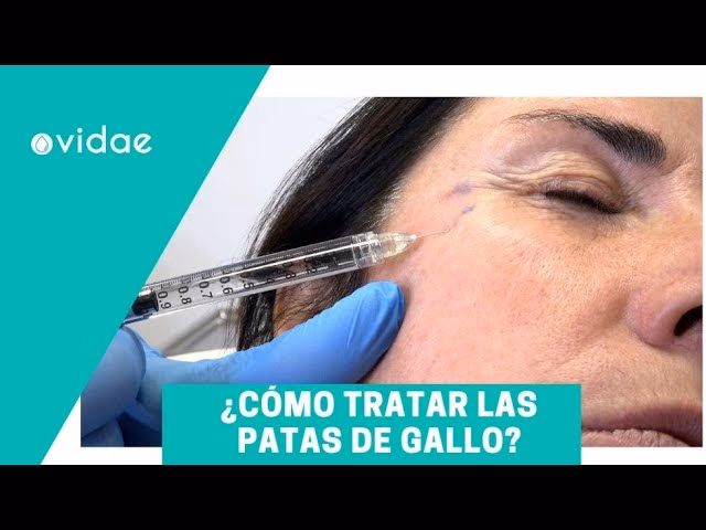 ¿Cómo se sacan las patas de gallo?