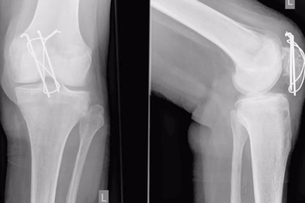 ¿Cuánto paga la ART por fractura de tibia?