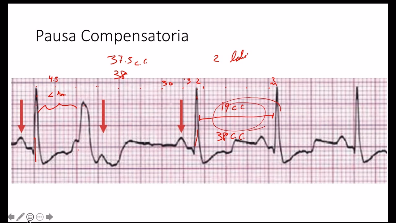 ¿Cómo calcular el tiempo en un electrocardiograma?