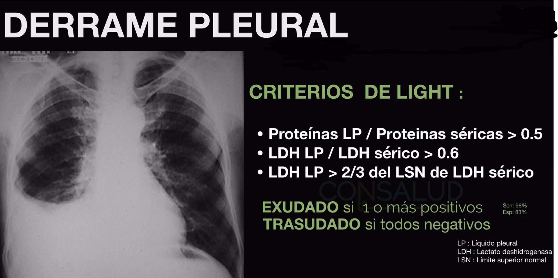 ¿Cuál es la diferencia entre los criterios de luz exudativa y transudativa?