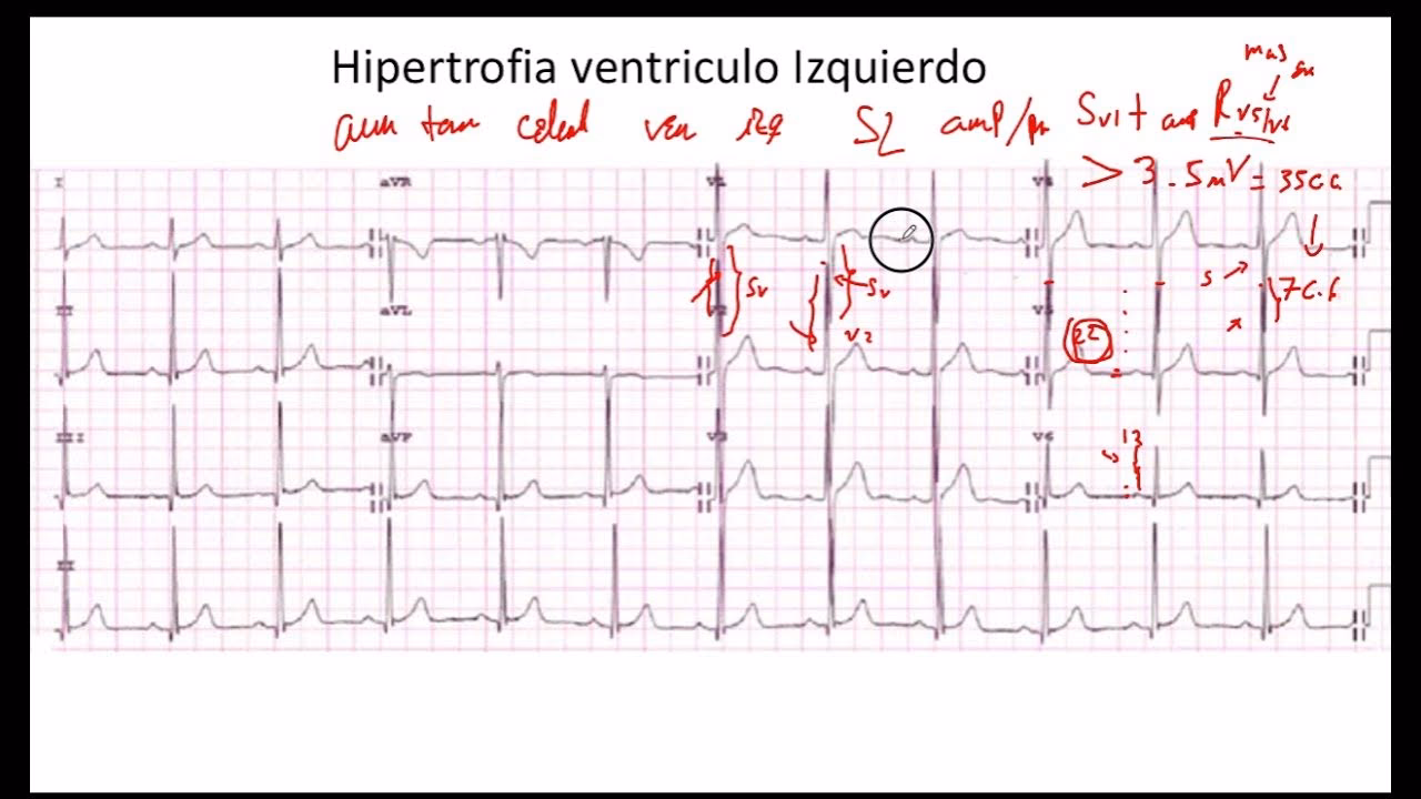 ¿Qué es el índice de Lewis?